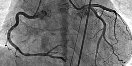 冠動脈造影検査